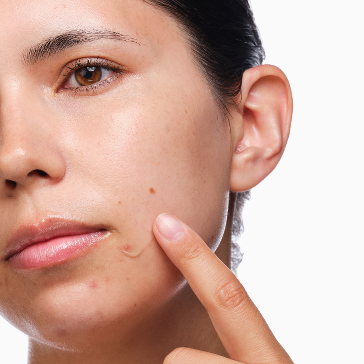 the-acne-set-g4 rdn-the-acne-set-application.png