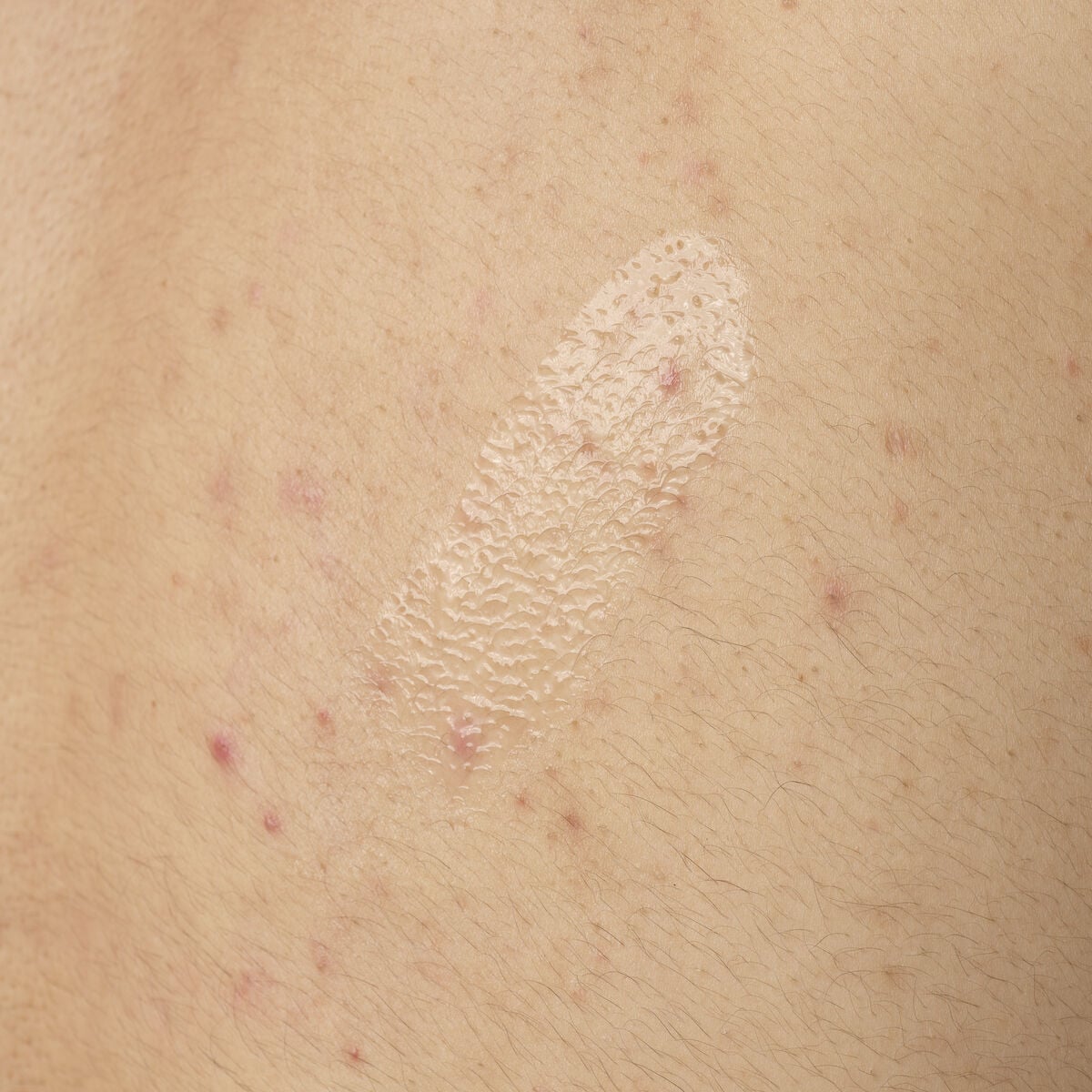 salicylic-acid-0-5-body-serum-v0 ORD-salicylic-acid-05-body-240ml-application.jpg