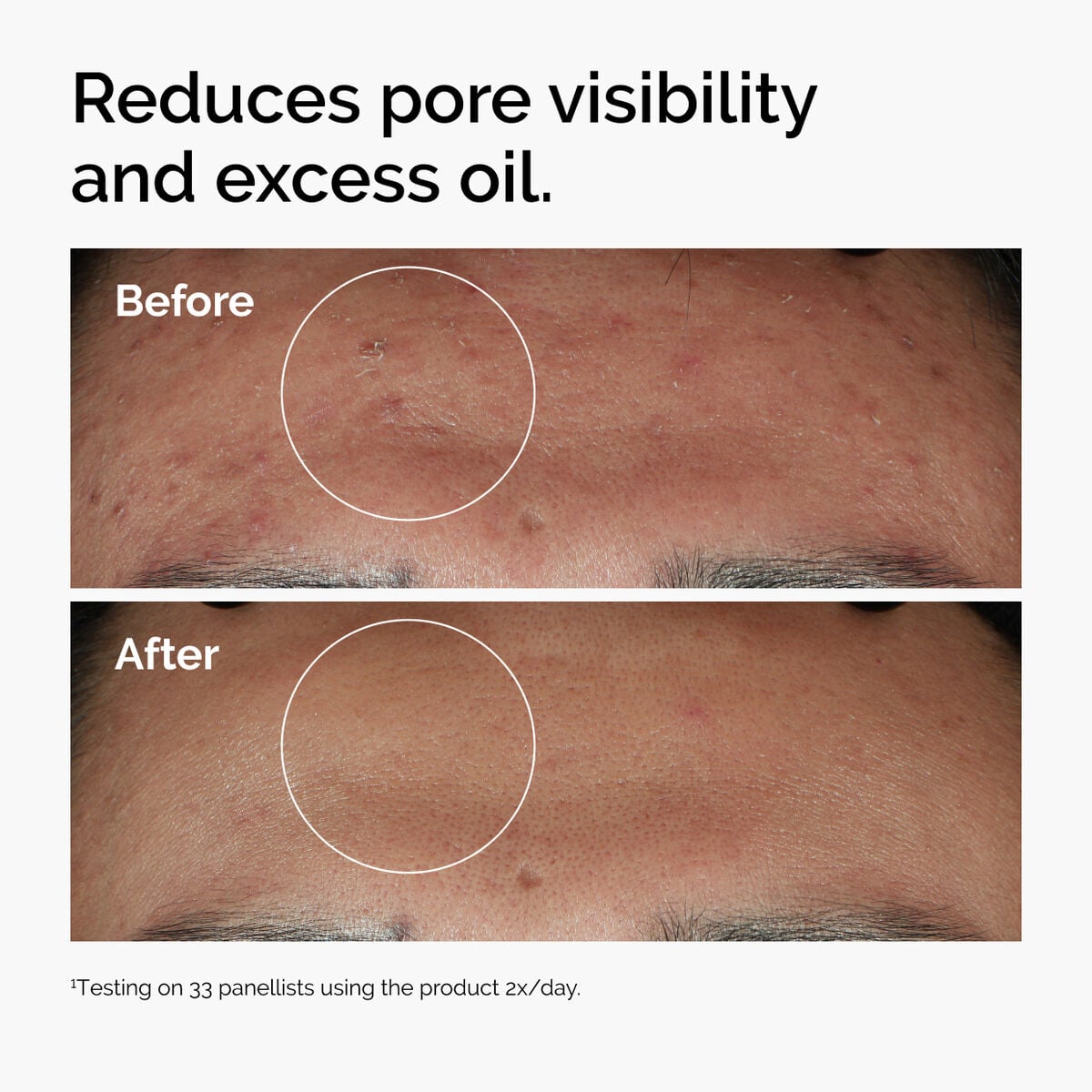 niacinamide-10-zinc-1-i4 ord-niacinamide-zinc-blemish-serum-before-after-pores.jpg