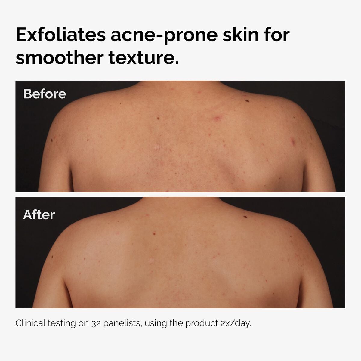 salicylic-acid-0-5-body-serum-v0 ord-salicylic-acid-body-serum-before-after-graphic-NA.jpg